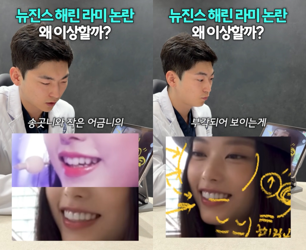 Did Haerin's Veneers Cost Her the Cat Smile That Made Her Famous?